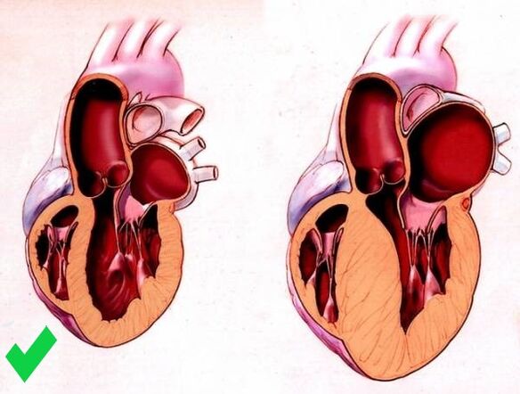 Cardione verhënnert ventrikulär Hypertrophie vum Häerz